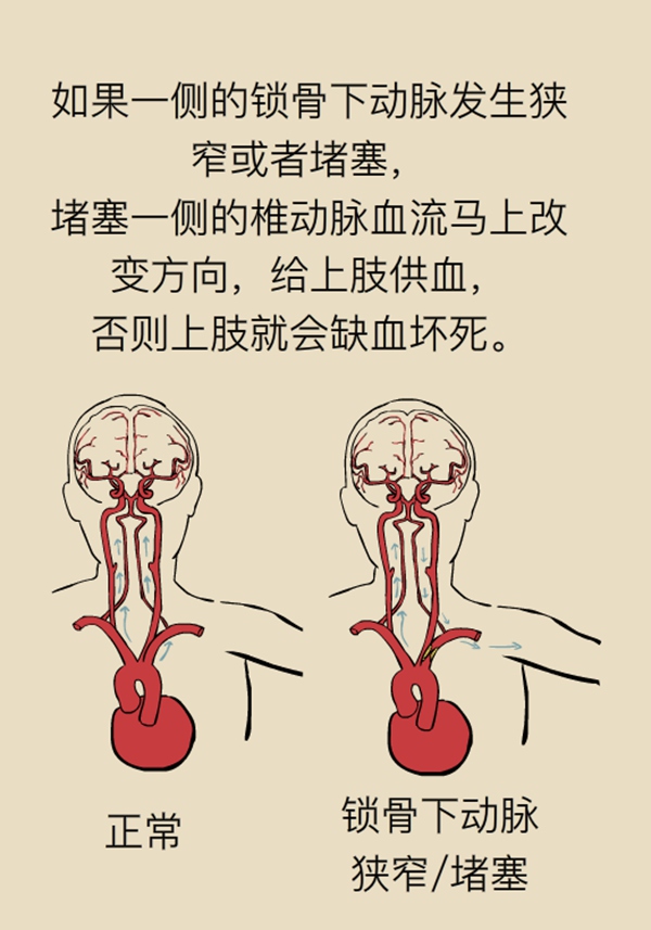 一侧脉搏明显减弱或摸不到?你可能患有"无脉症"