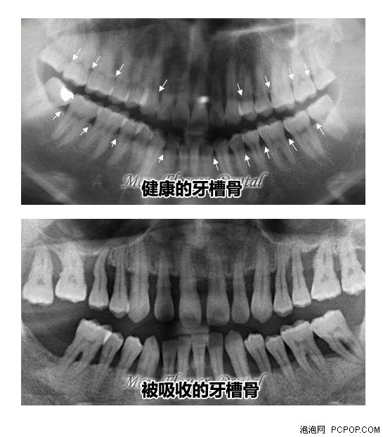 牙槽骨一二三四类图片图片