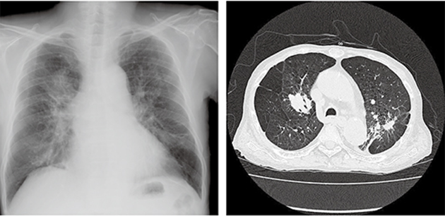 尘肺x线表现图片图片